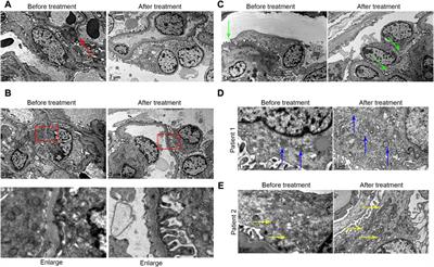 Podocytes are likely the therapeutic target of IgA nephropathy with isolated hematuria: Evidence from repeat renal biopsy